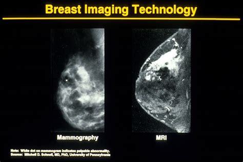 the villages breast cancer mammogram images|Understanding Your Mammogram Results .